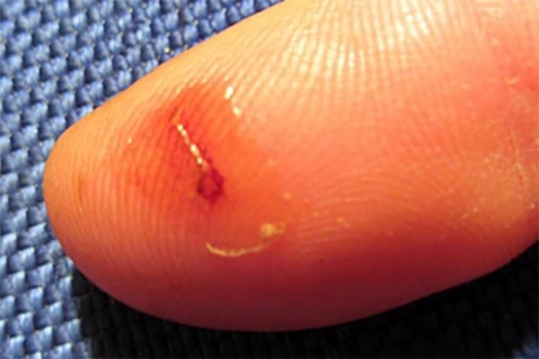 Медицинский клей БФ-6 – клей для заживления ран и порезов