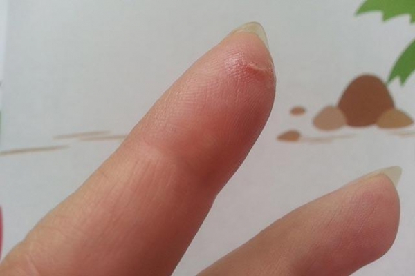 Медицинский клей БФ-6 – клей для заживления ран и порезов